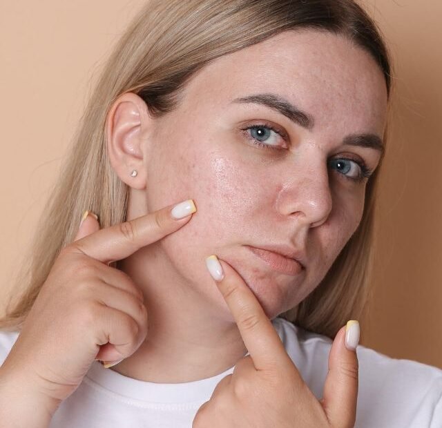 Como tratar o inchaço e a acne que surgem de surpresa dominando a make maquiagem batom blush geane sousa capa Web Stories