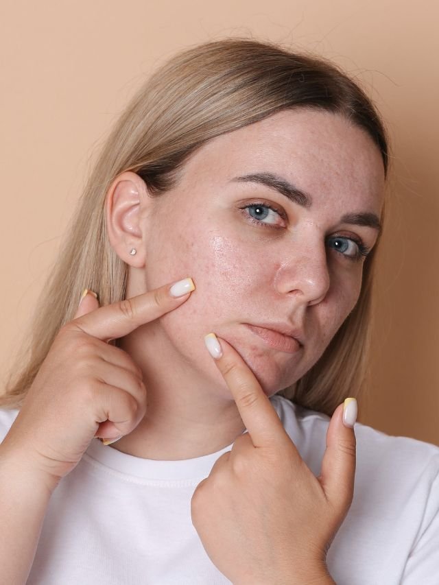 Como tratar o inchaço e a acne que surgem de surpresa?