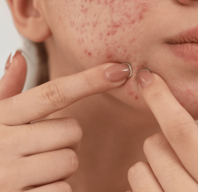 Quais são os tratamentos para cicatrizes de acne, dominando a make maquiagem batom blush geane sousa capa Web Stories