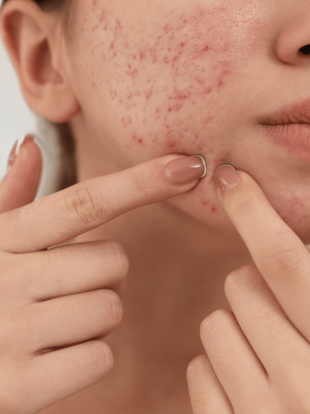 Quais são os tratamentos para cicatrizes de acne?